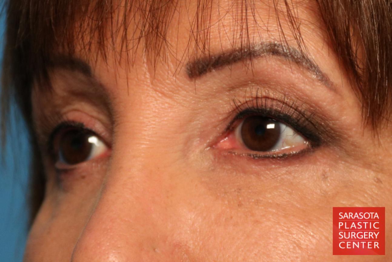 Eyelid Lift: Patient 9 - After 4