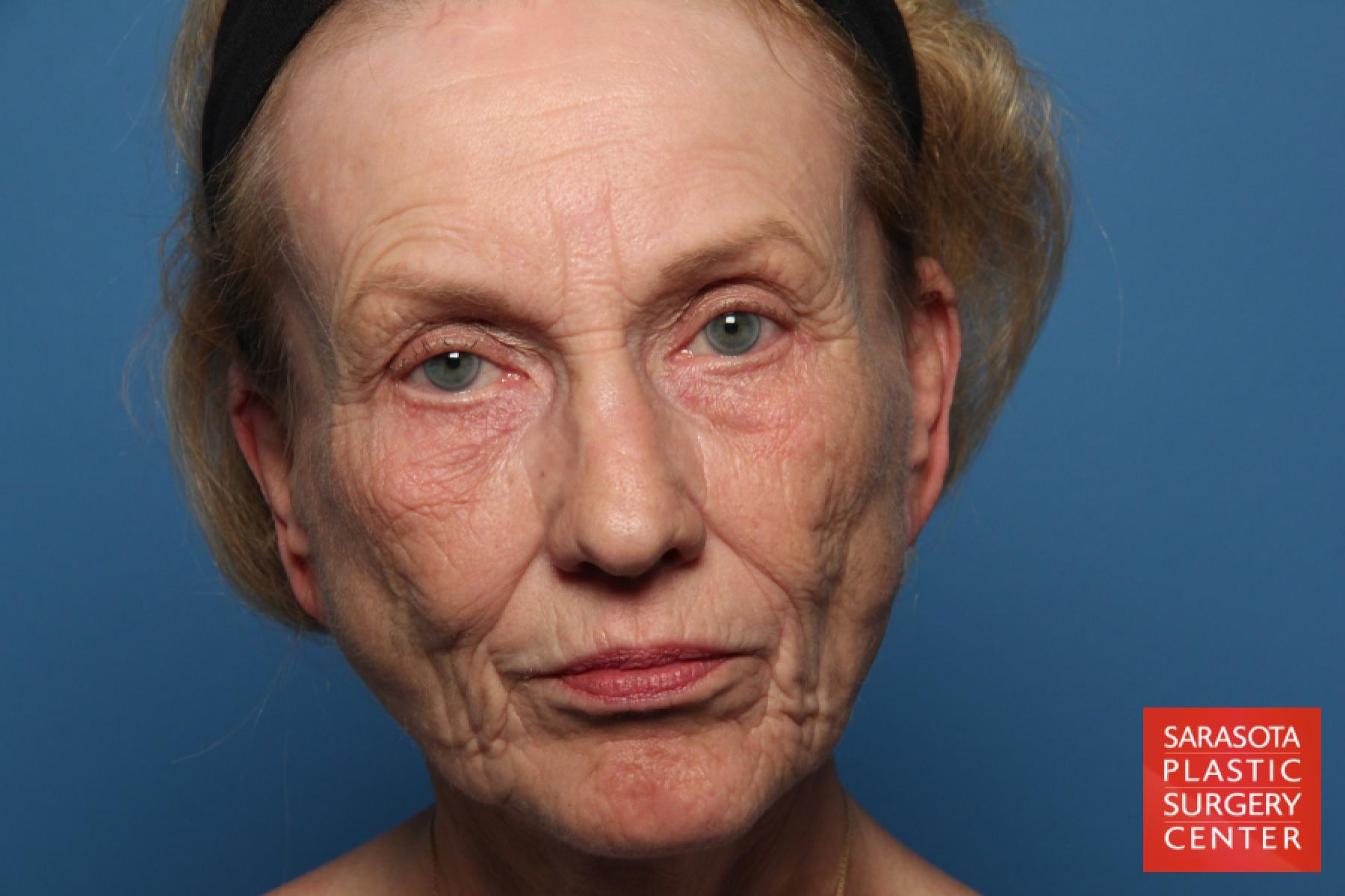 Fat Transfer - Face: Patient 8 - Before 
