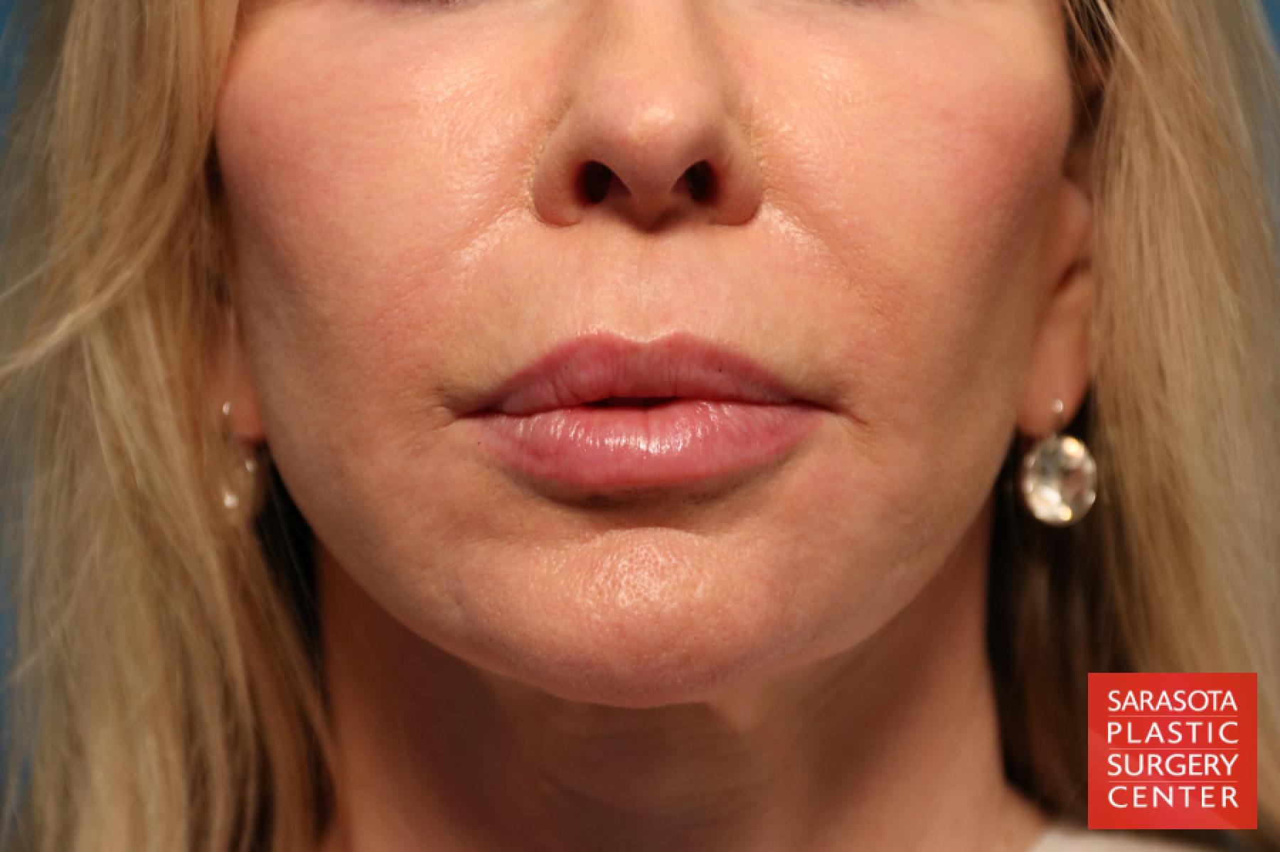 Laser Skin Resurfacing - Face: Patient 7 - After  