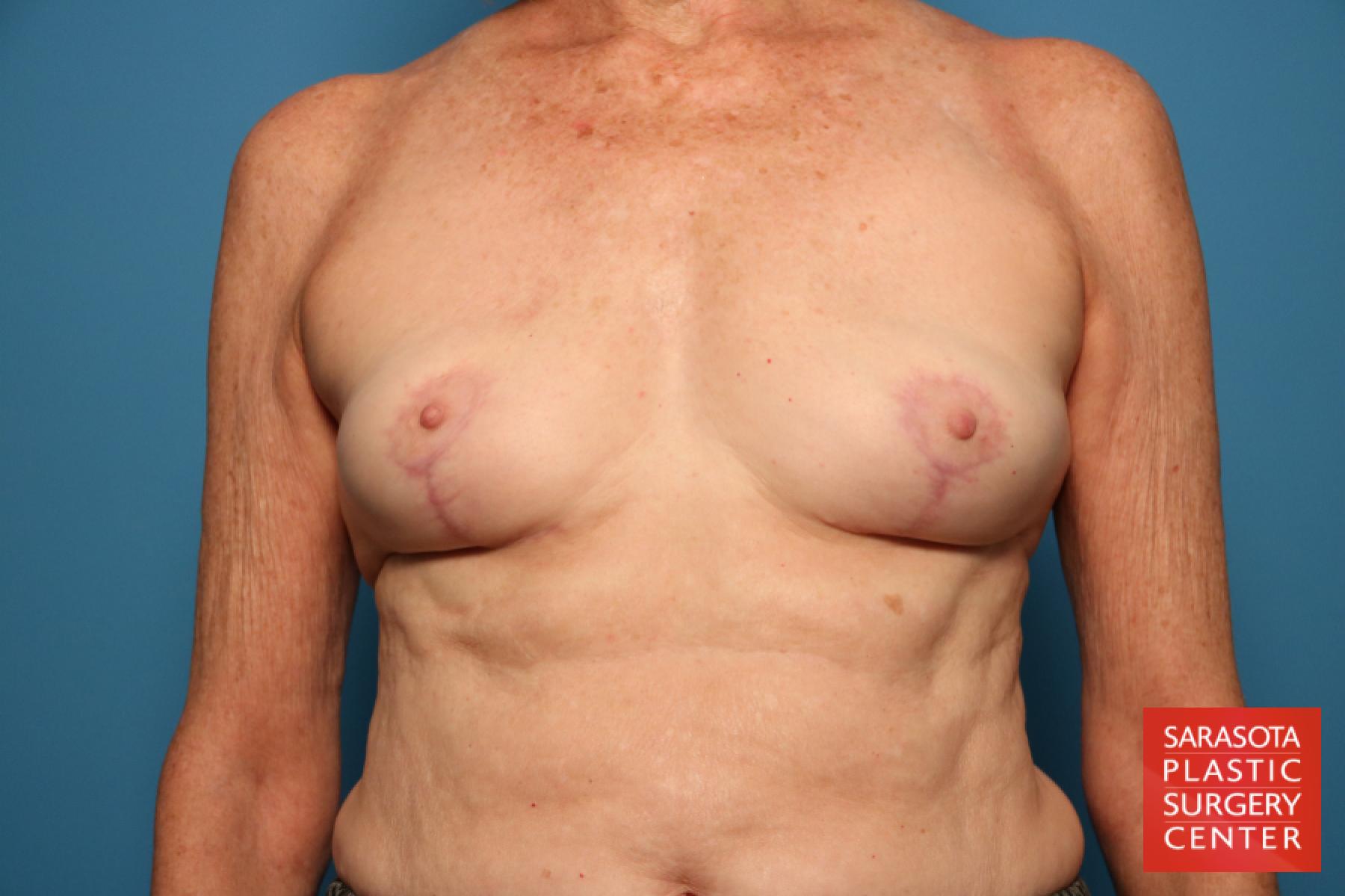 Breast Implant Removal With Lift: Patient 1 - After 1