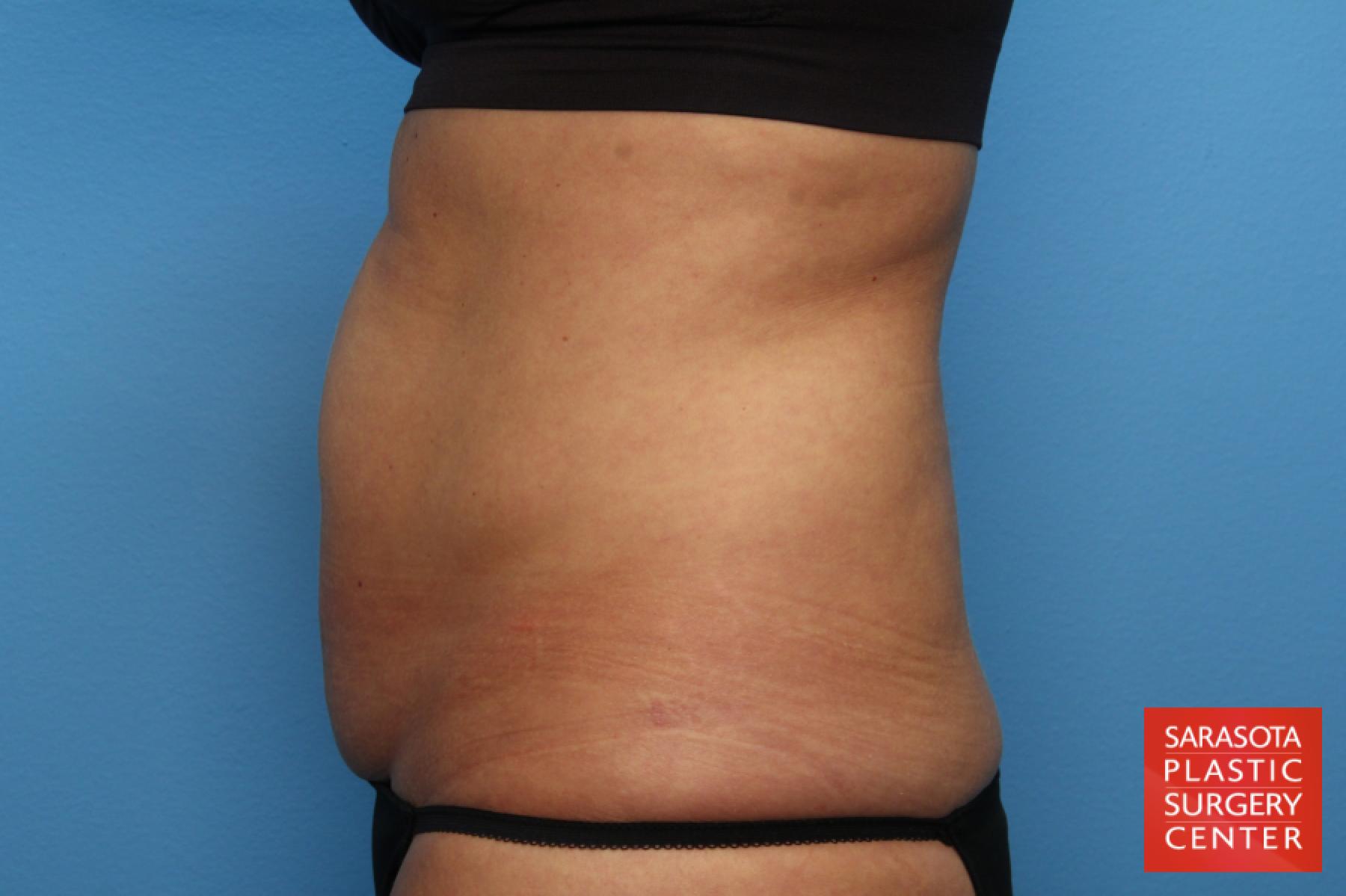 Tummy Tuck: Patient 25 - Before and After 3