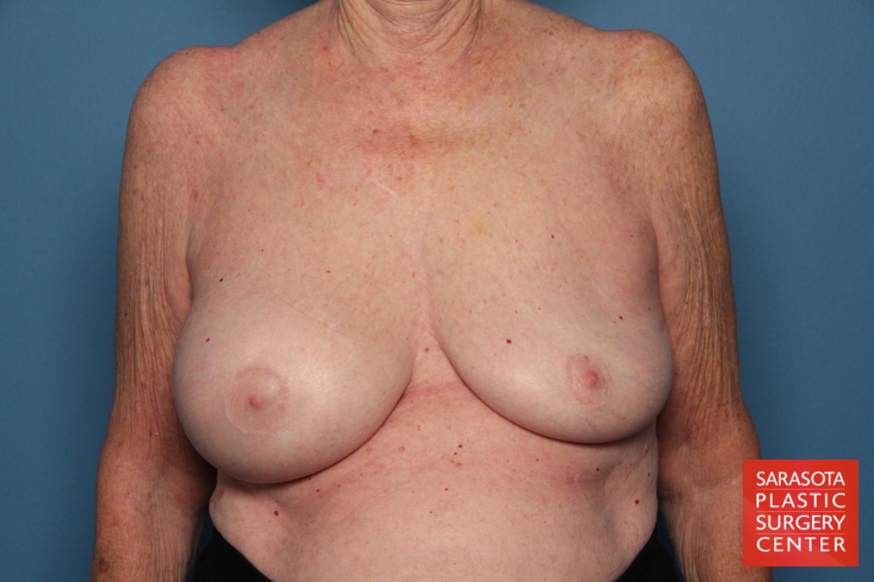 Breast Implant Exchange: Patient 7 - Before 