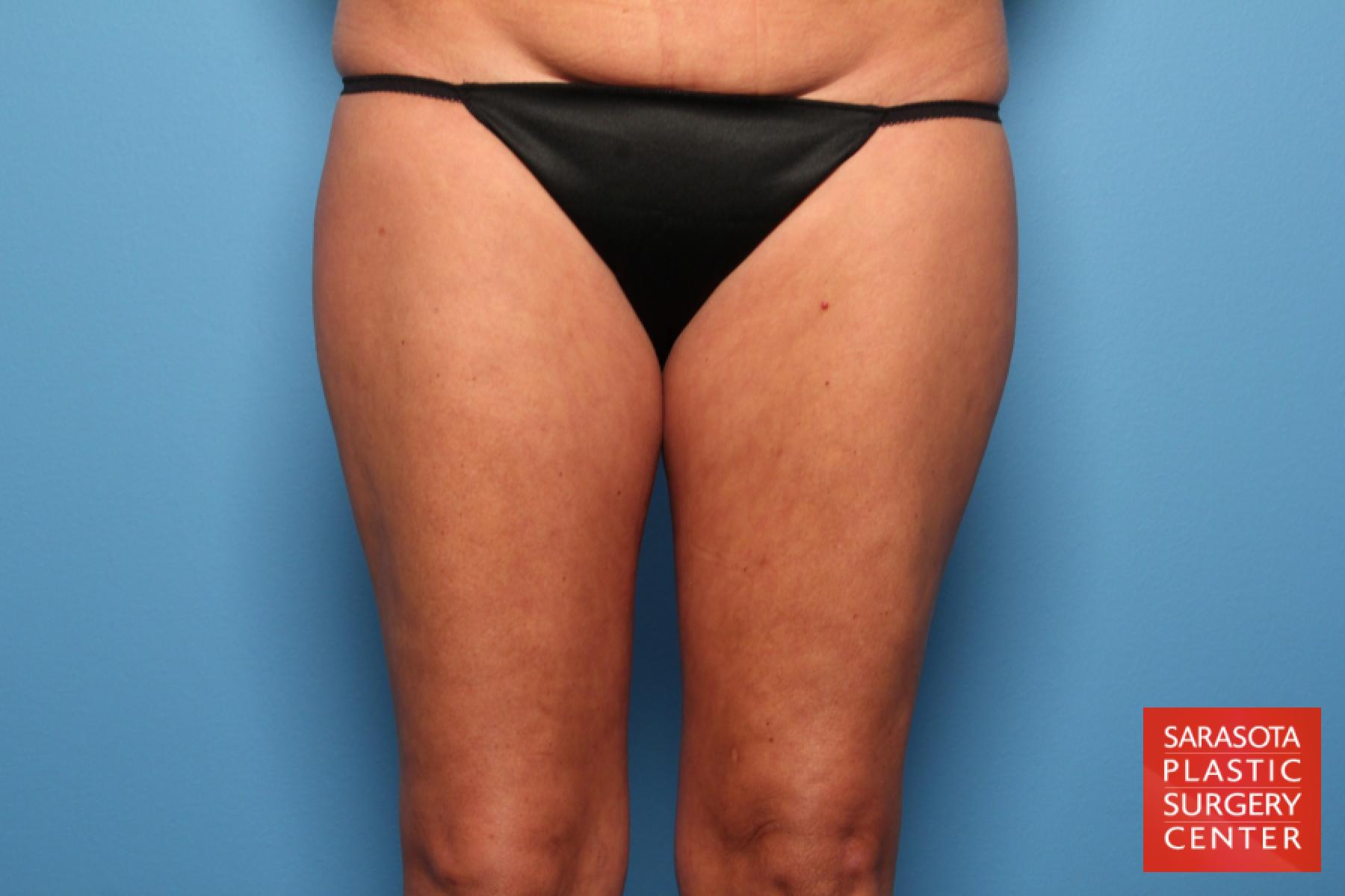 Liposuction: Patient 12 - Before 1