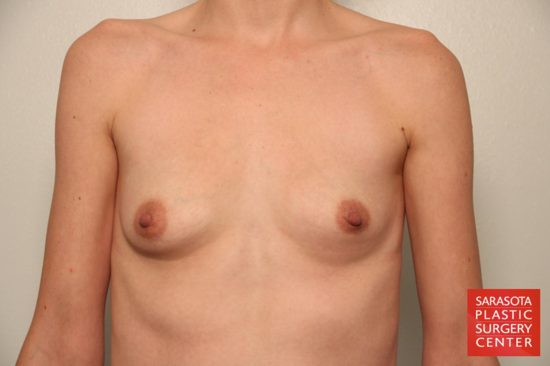 Breast Augmentation: Patient 62 - Before 1
