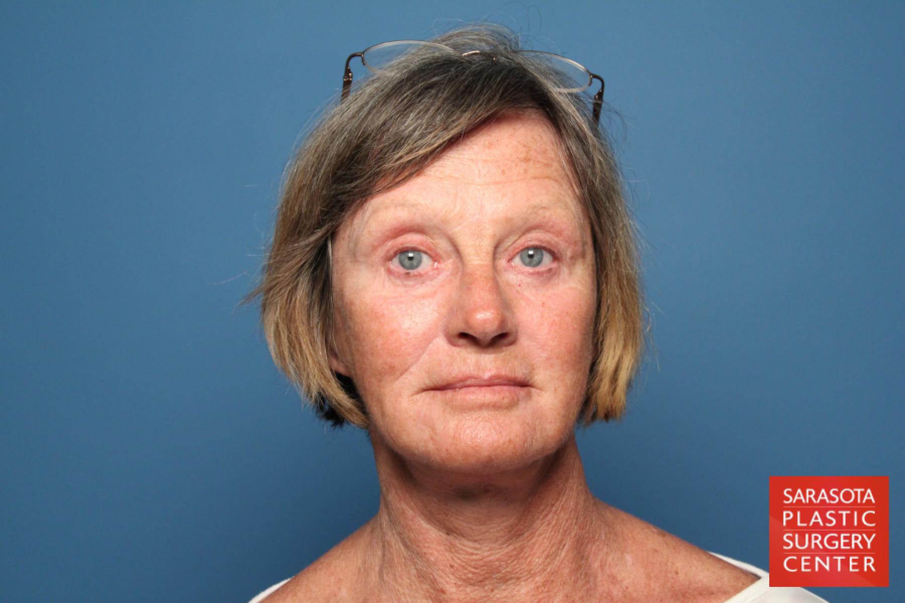Laser Skin Resurfacing - Face: Patient 11 - After 1