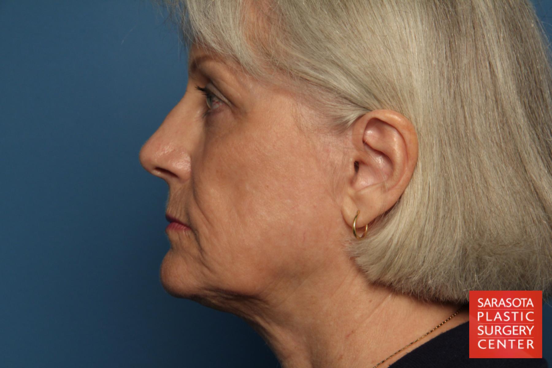 Laser Skin Resurfacing - Face: Patient 3 - After 5