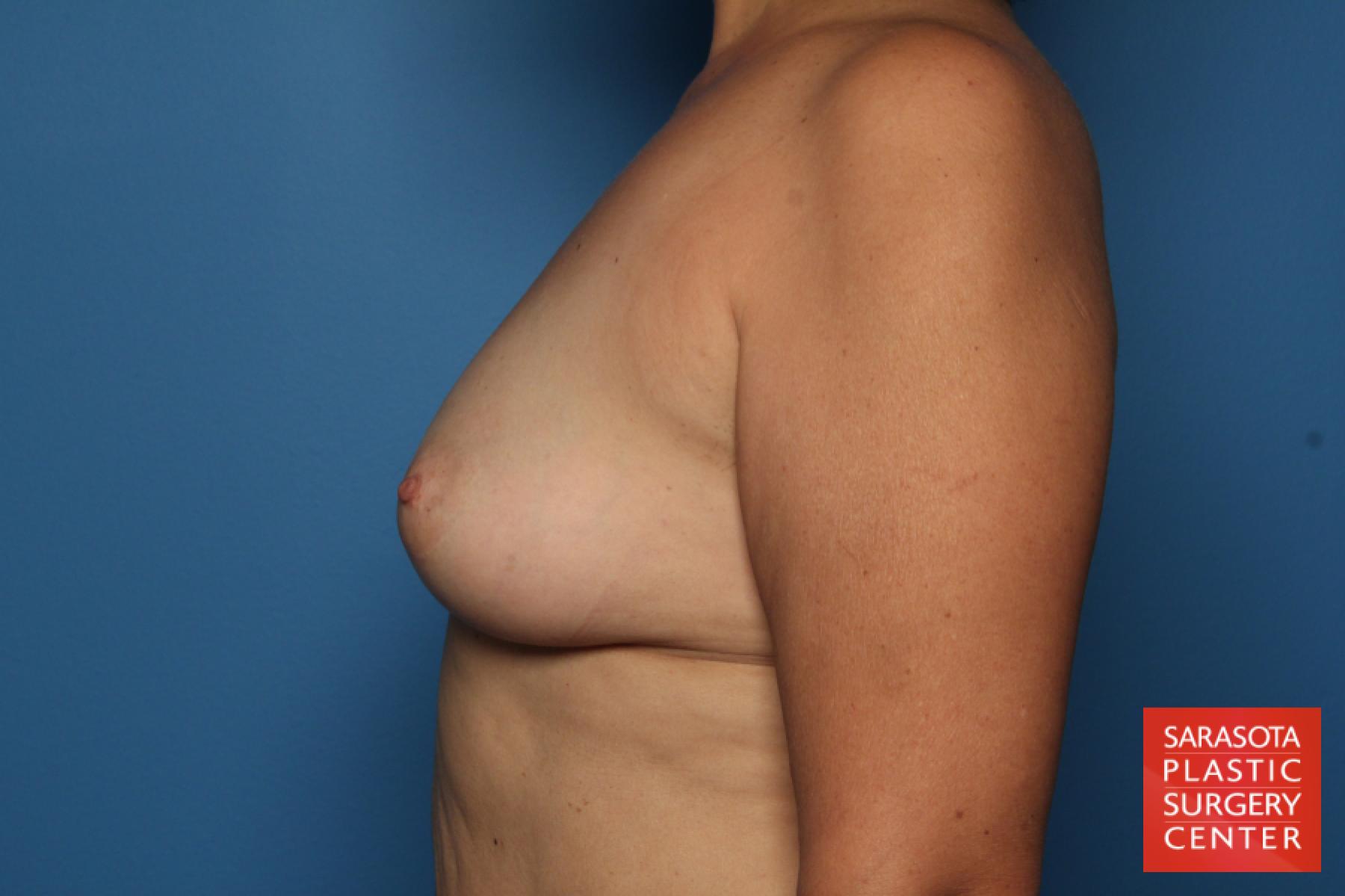 Breast Augmentation: Patient 42 - Before and After 3