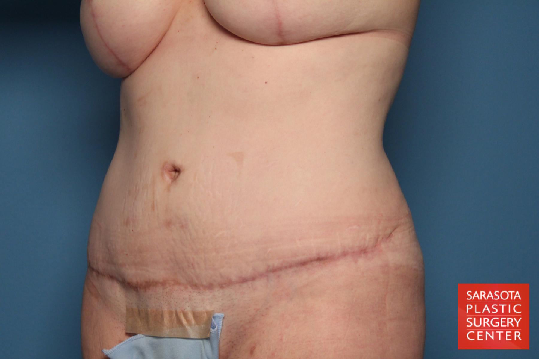 Tummy Tuck: Patient 17 - After 2