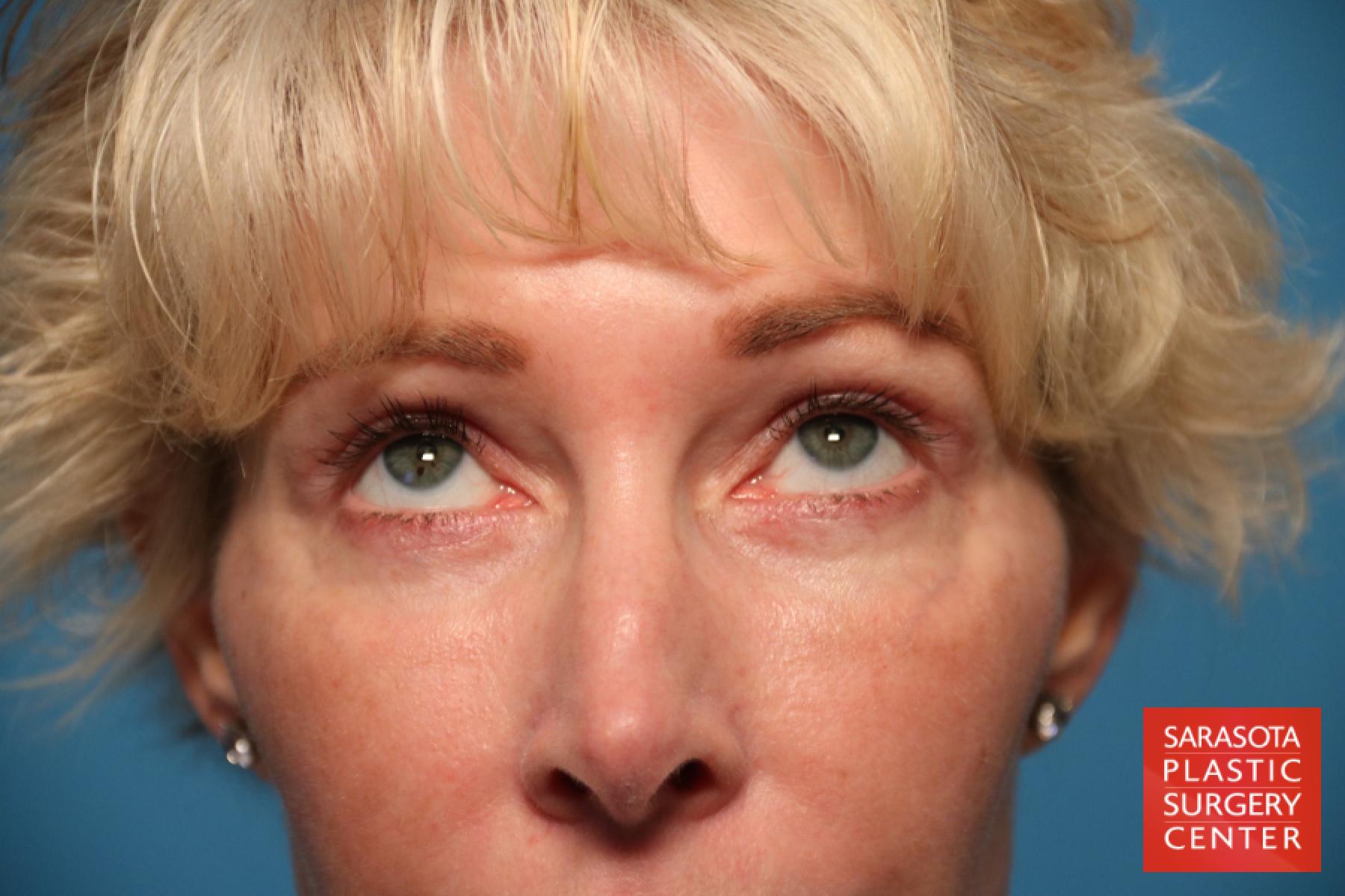 Eyelid Lift: Patient 12 - After 2