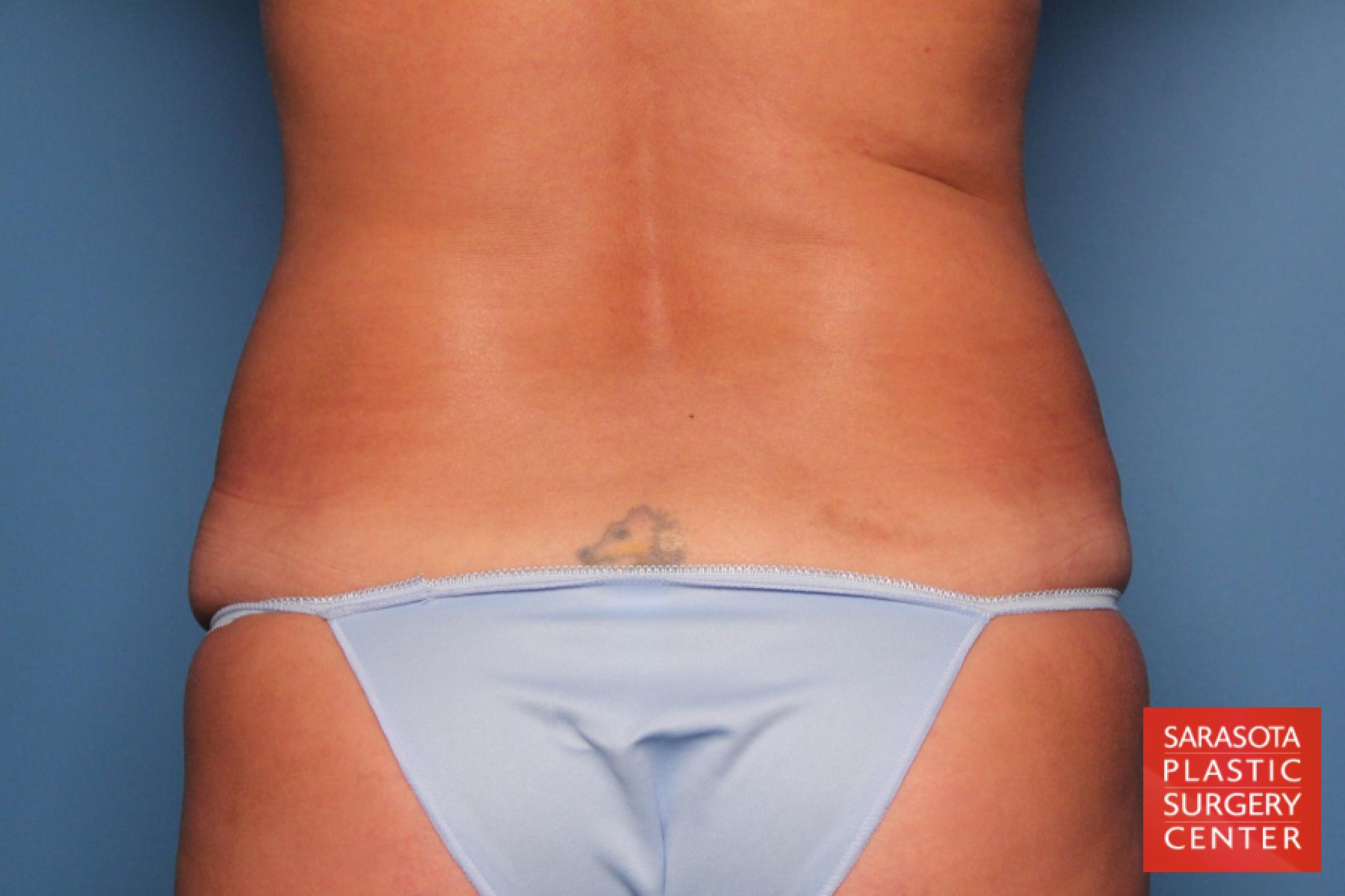 Tummy Tuck: Patient 12 - After 5