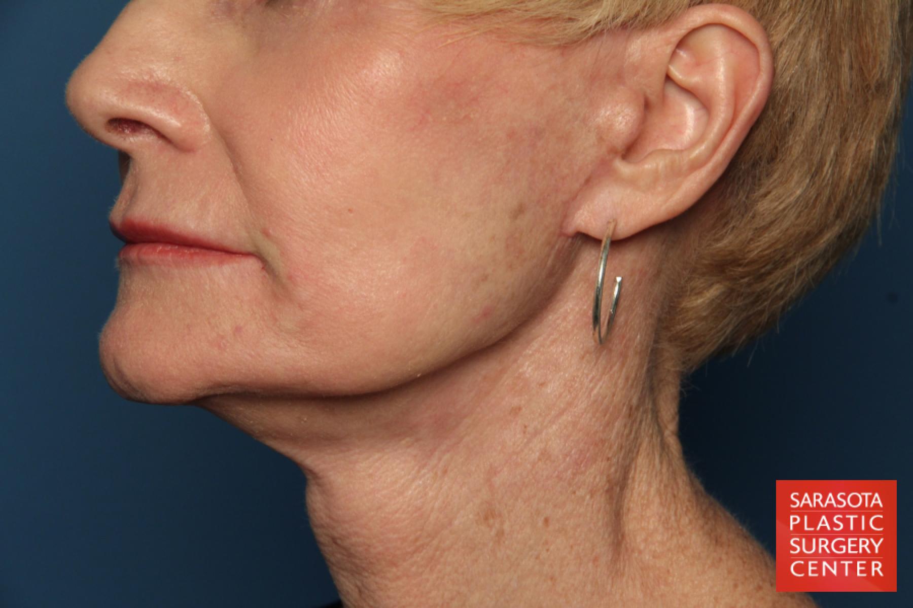 Laser Skin Resurfacing - Face: Patient 15 - After 2