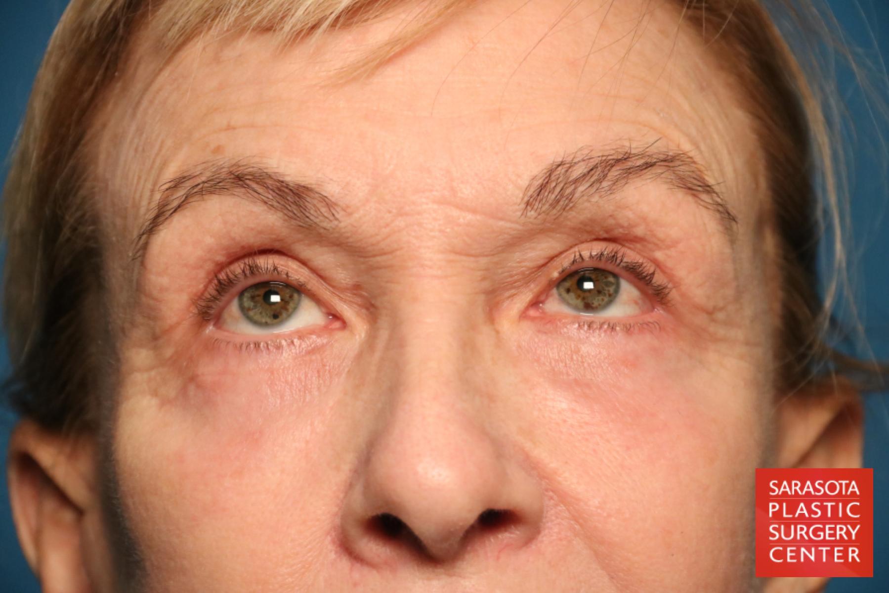 Eyelid Lift: Patient 43 - After 2