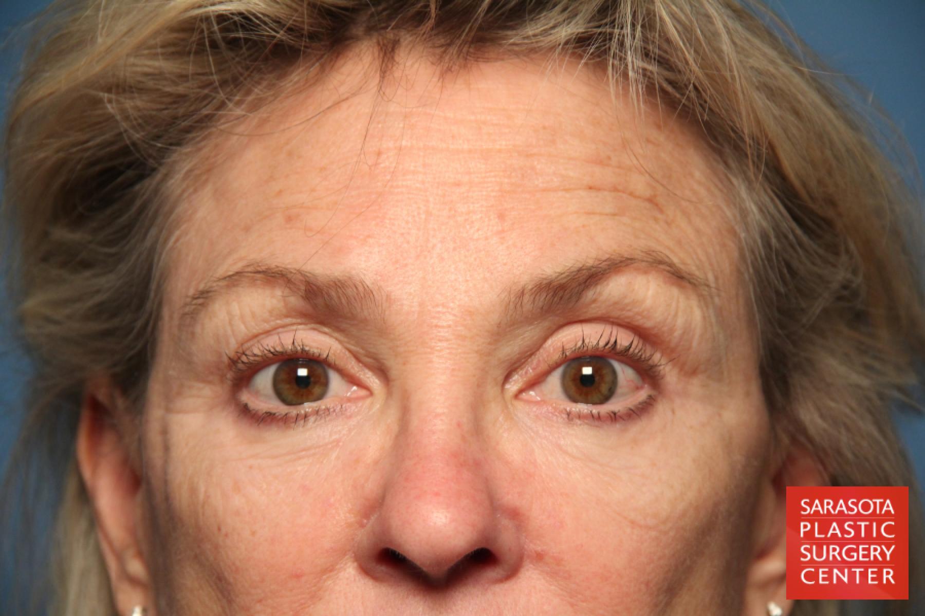 Laser Skin Resurfacing - Face: Patient 9 - Before 4