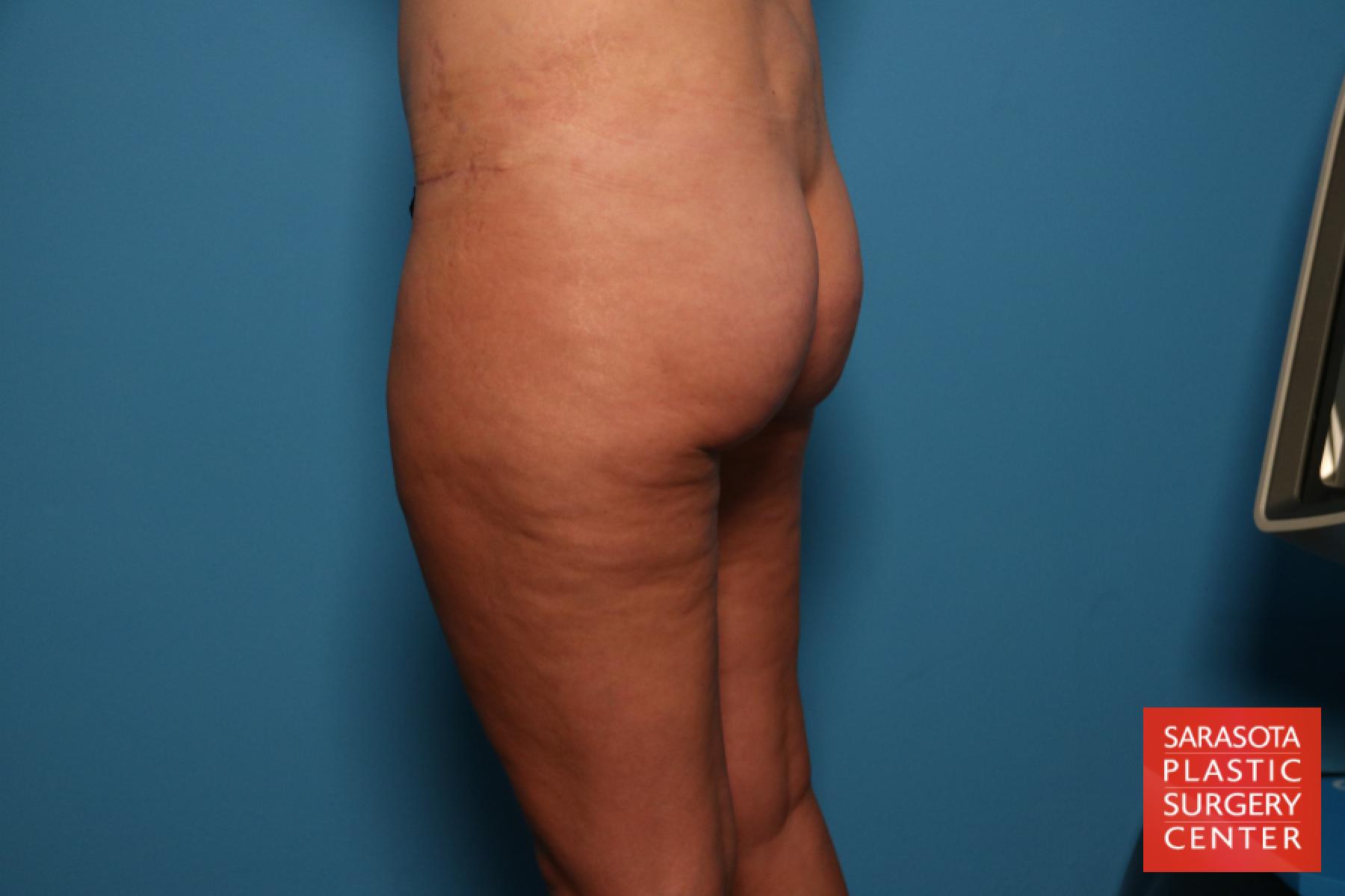Liposuction: Patient 7 - After 4