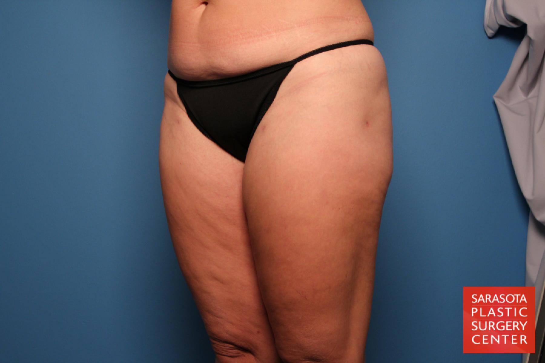 Liposuction: Patient 6 - After 2