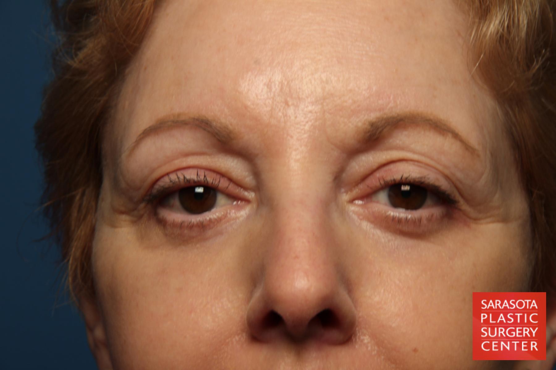 Eyelid Lift: Patient 41 - After 1