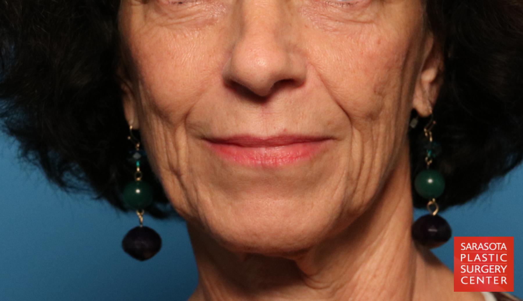 Rhinoplasty: Patient 20 - After 