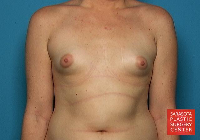 Breast Augmentation - Subfascial: Patient 5 - After  