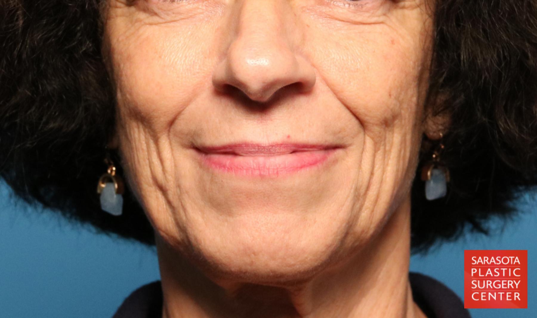 Rhinoplasty: Patient 20 - Before 