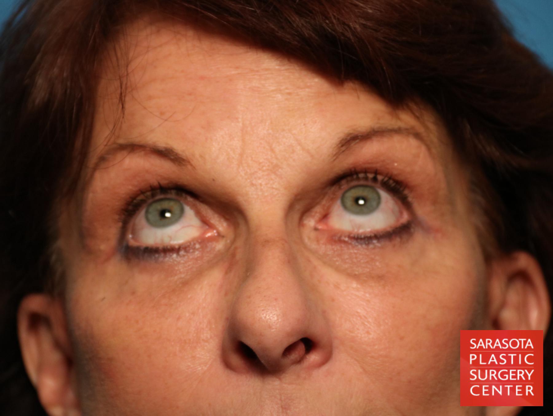 Eyelid Surgery: Patient 25 - After 2