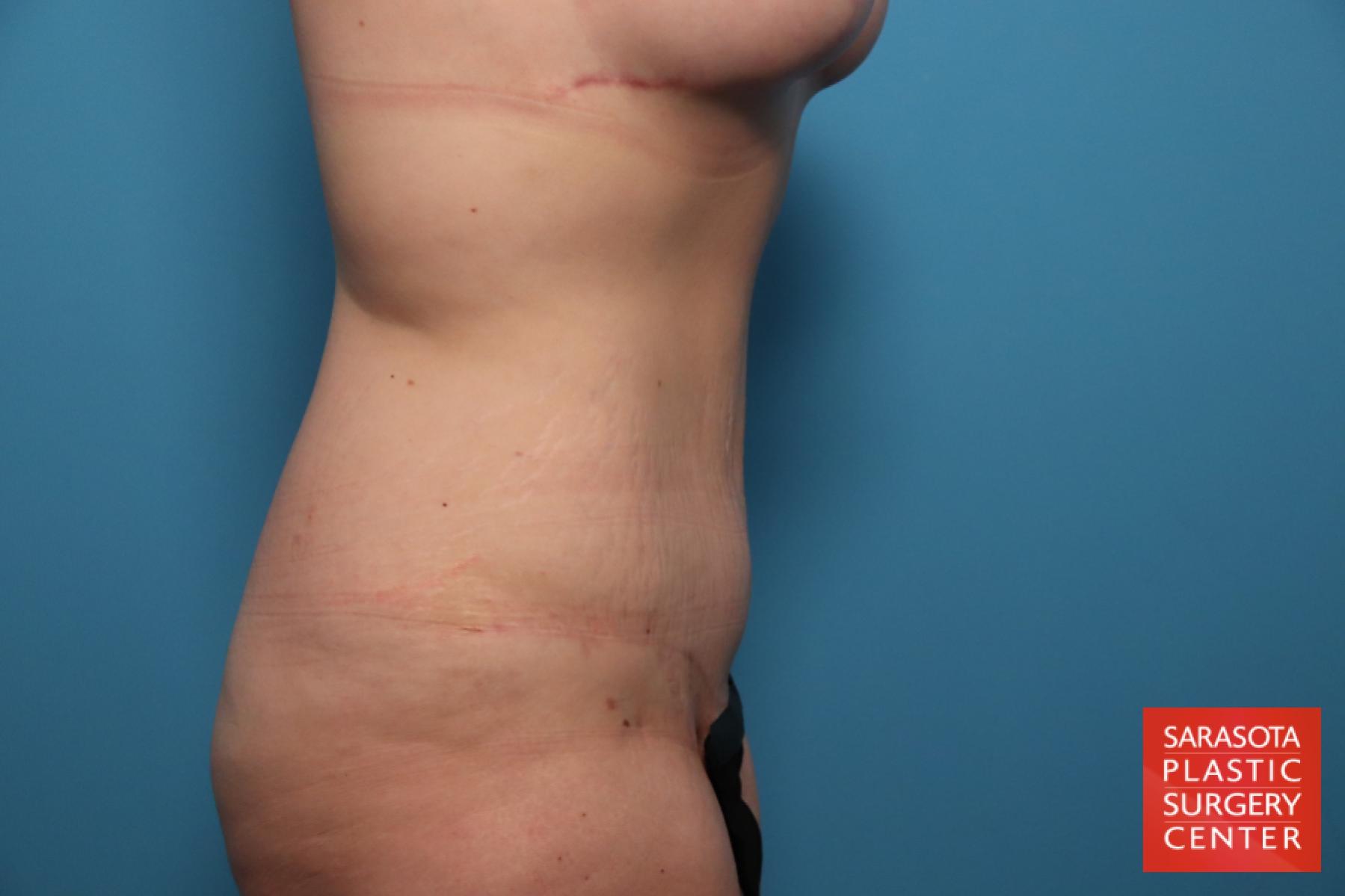 Mommy Makeover: Patient 6 - After 9