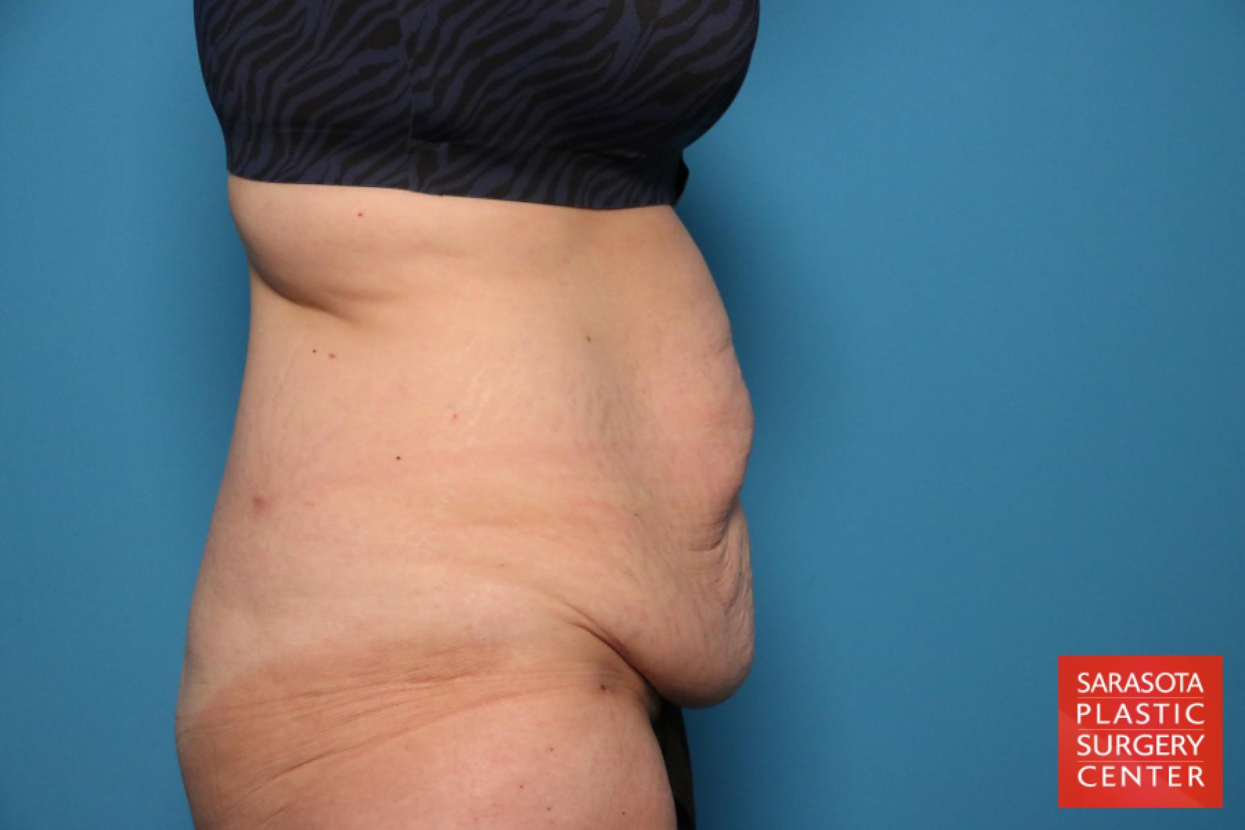 Mommy Makeover: Patient 6 - Before and After 9