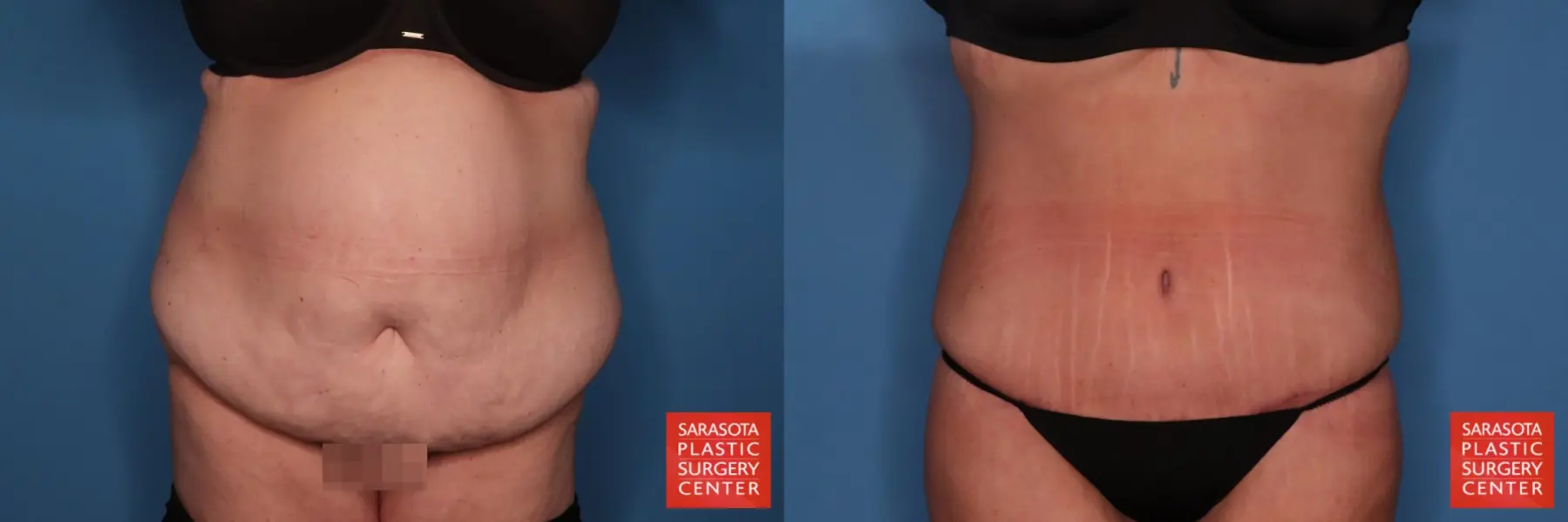 Abdominoplasty: Patient 1 - Before and After  