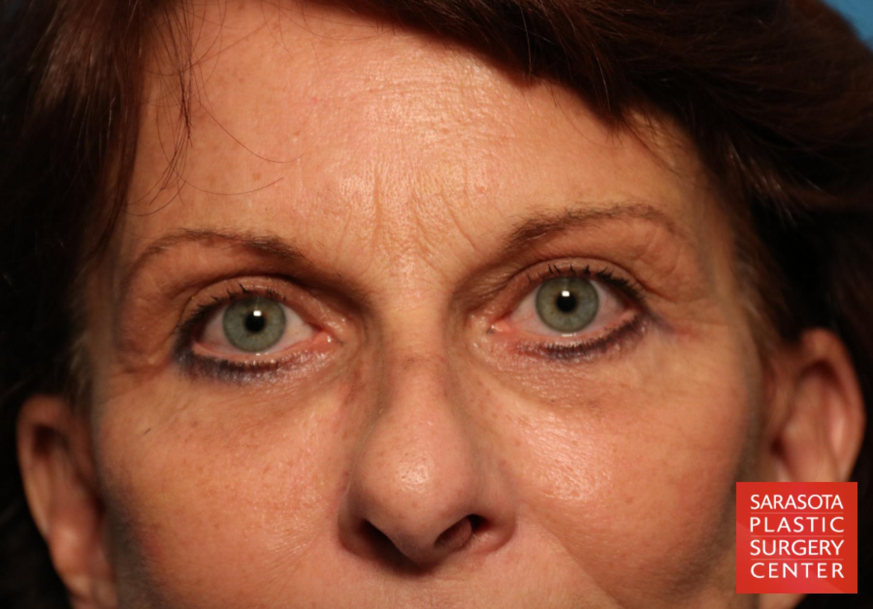 Eyelid Surgery: Patient 25 - After 