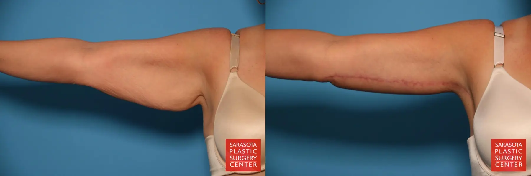 Arm Lift: Patient 24 - Before and After  