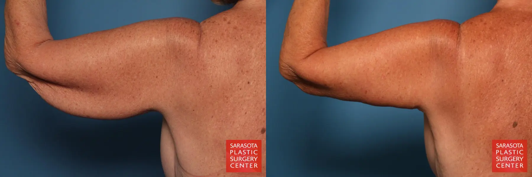 Arm Lift: Patient 31 - Before and After 6