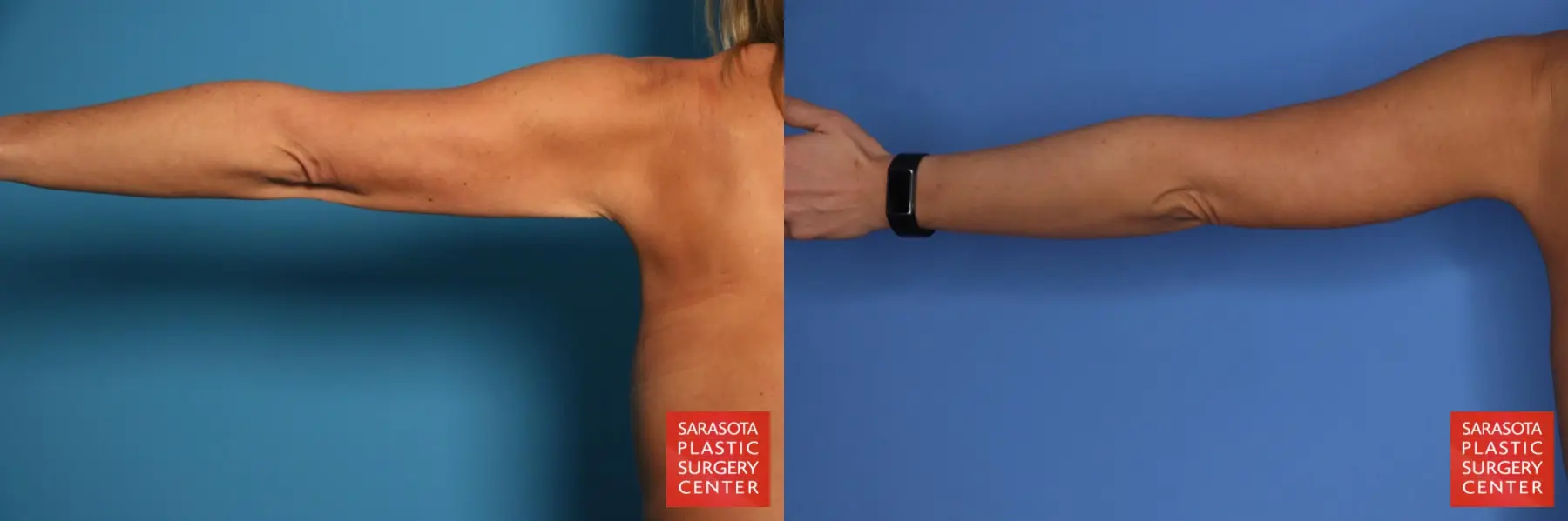 Arm Lift: Patient 27 - Before and After 5
