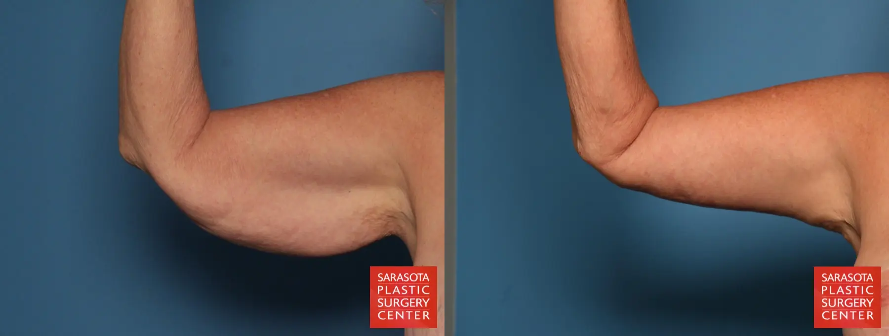 Arm Lift: Patient 31 - Before and After 2