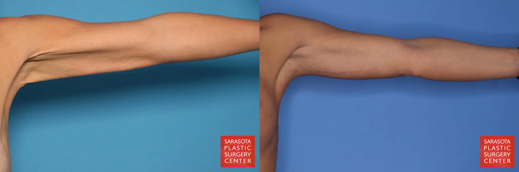 Arm Lift: Patient 27 - Before and After 3