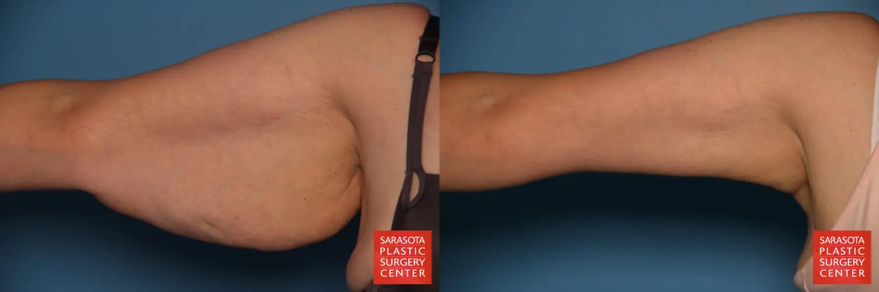 Arm Lift: Patient 25 - Before and After 1