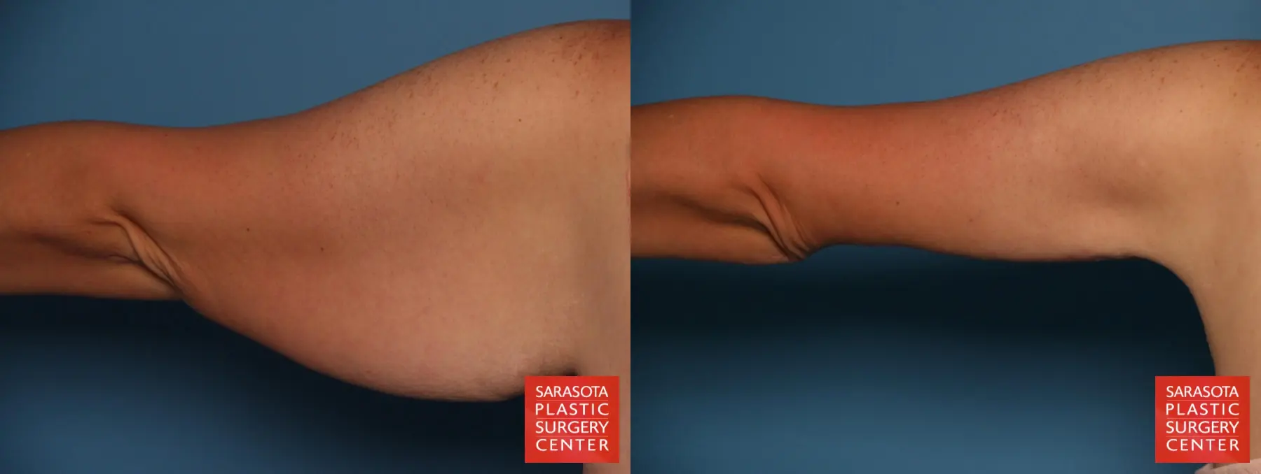 Arm Lift: Patient 25 - Before and After 5