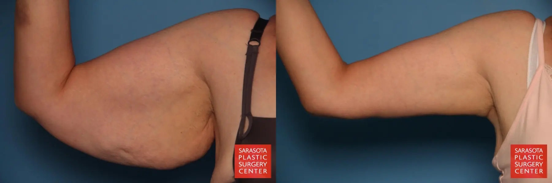 Arm Lift: Patient 25 - Before and After 2