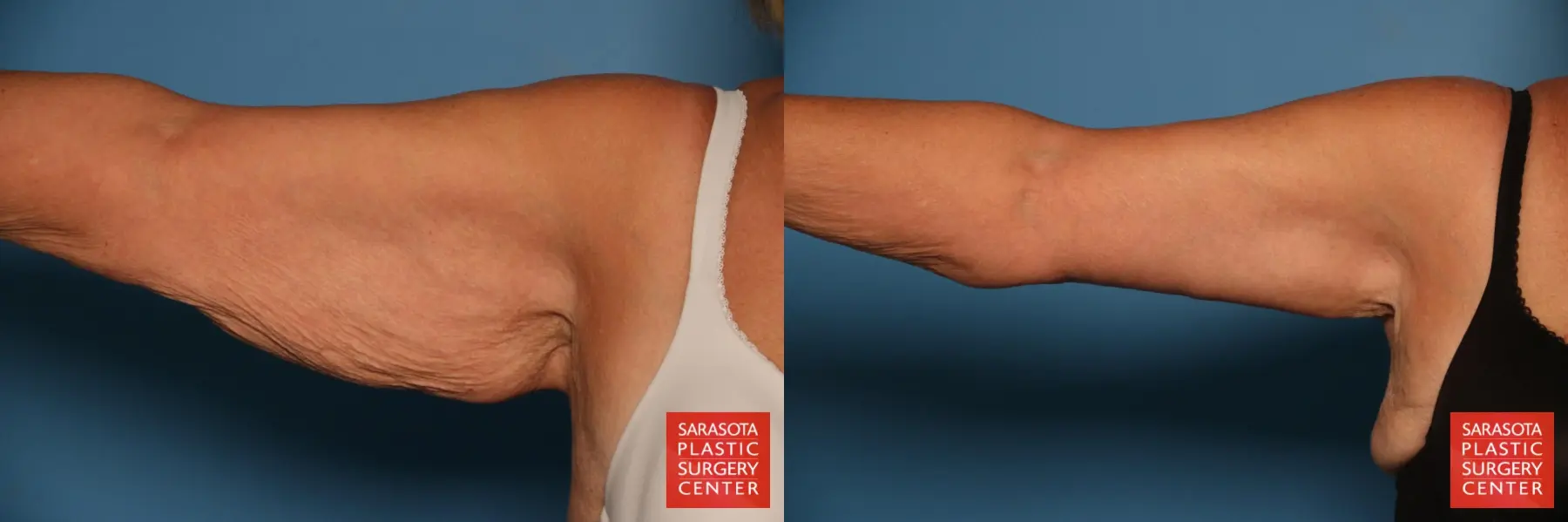 Arm Lift: Patient 37 - Before and After  