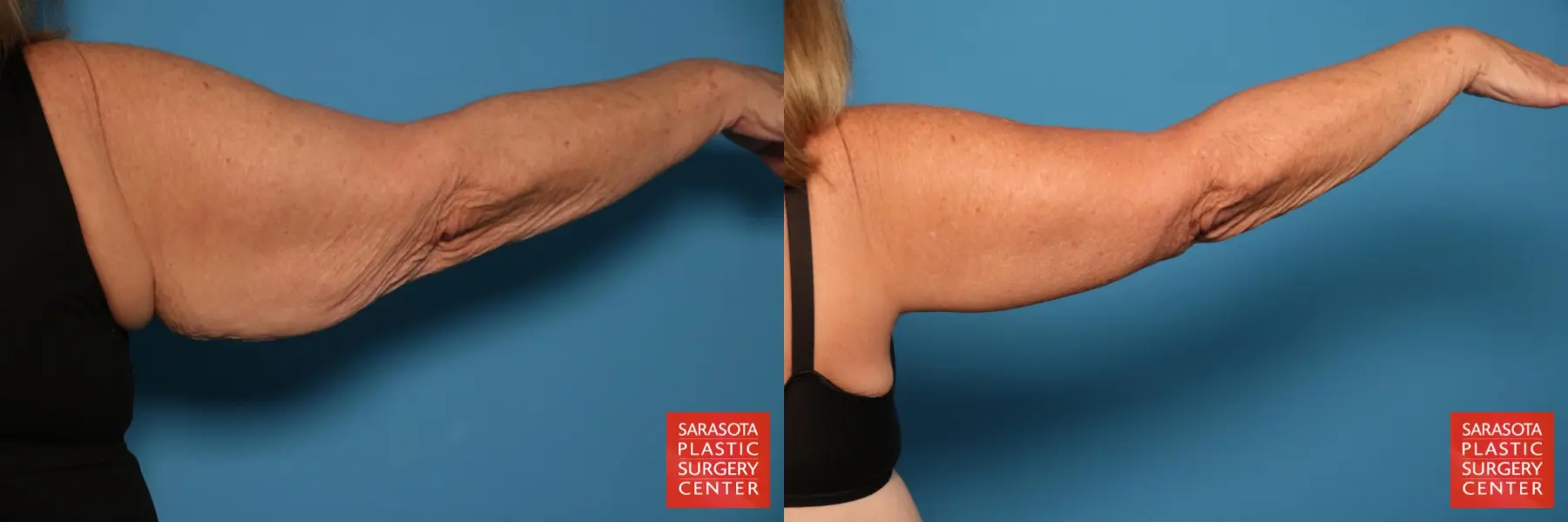 Arm Lift: Patient 23 - Before and After 7