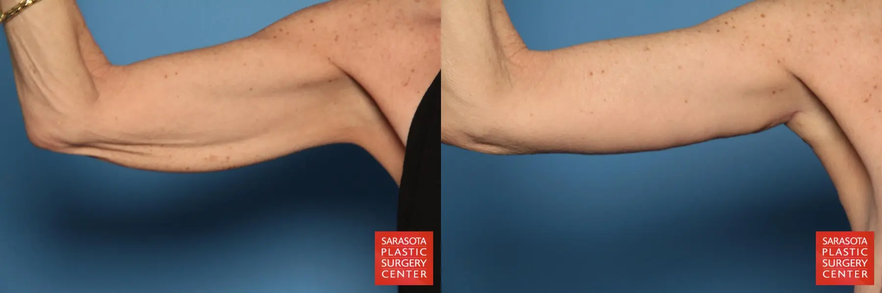 Arm Lift: Patient 13 - Before and After  