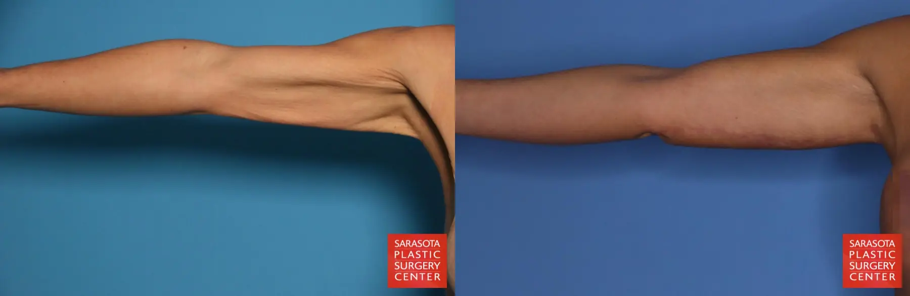 Arm Lift: Patient 27 - Before and After  