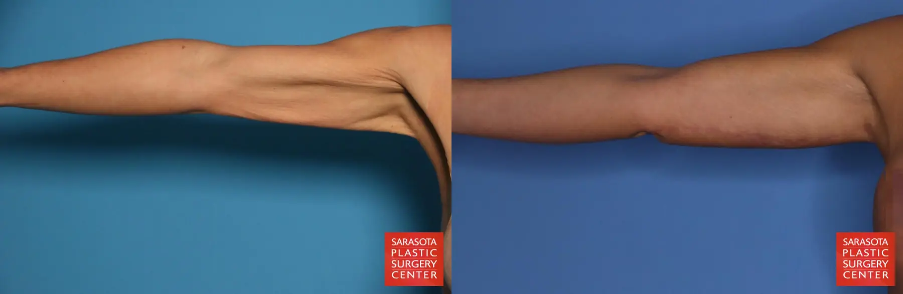 Arm Lift: Patient 27 - Before and After 1