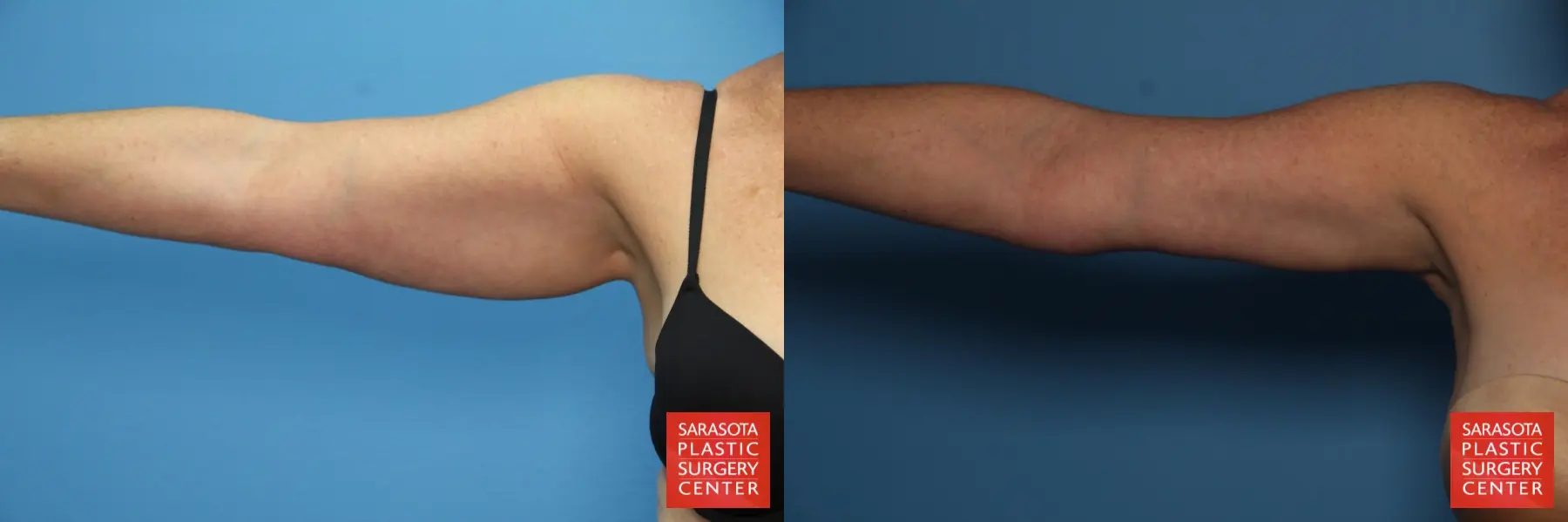 Arm Lift: Patient 14 - Before and After  