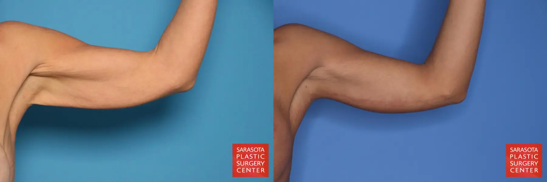 Arm Lift: Patient 27 - Before and After 4