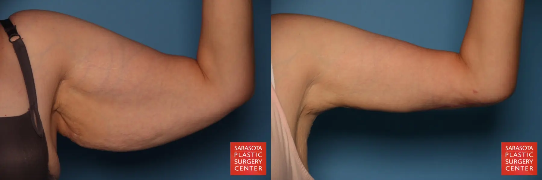 Arm Lift: Patient 25 - Before and After 4