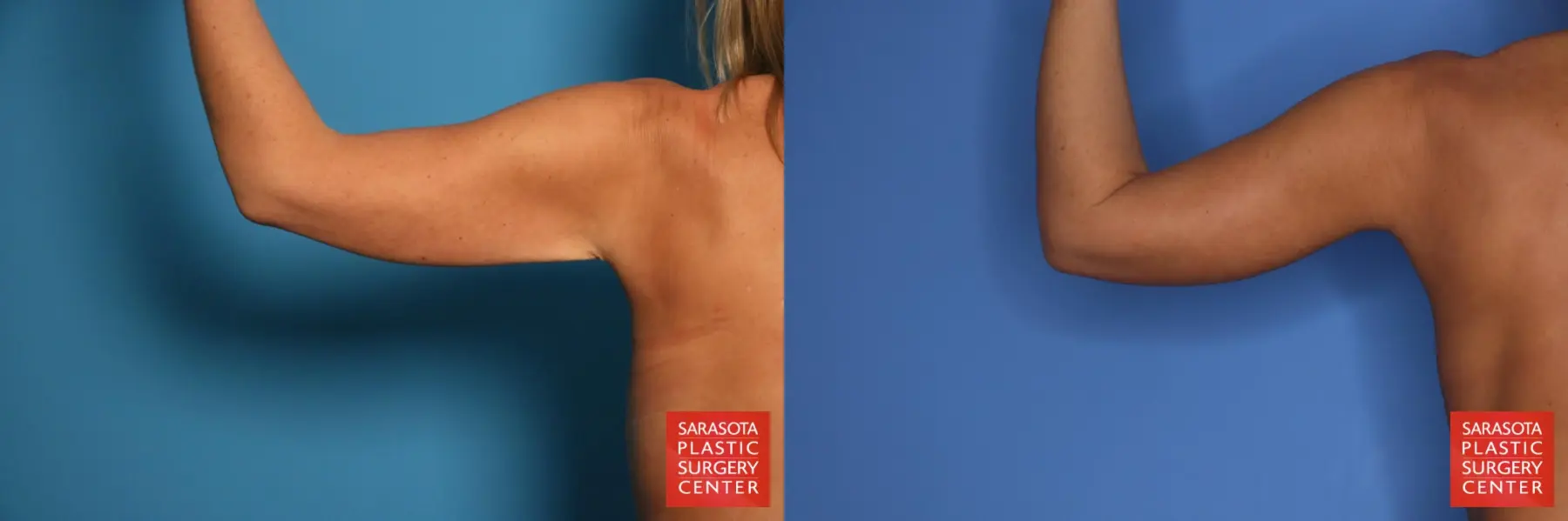 Arm Lift: Patient 27 - Before and After 6