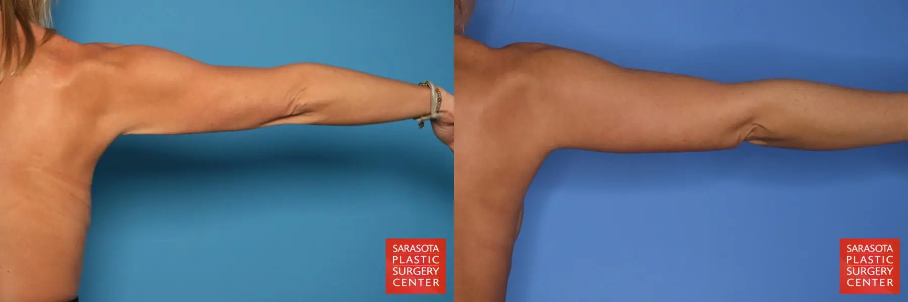 Arm Lift: Patient 27 - Before and After 7