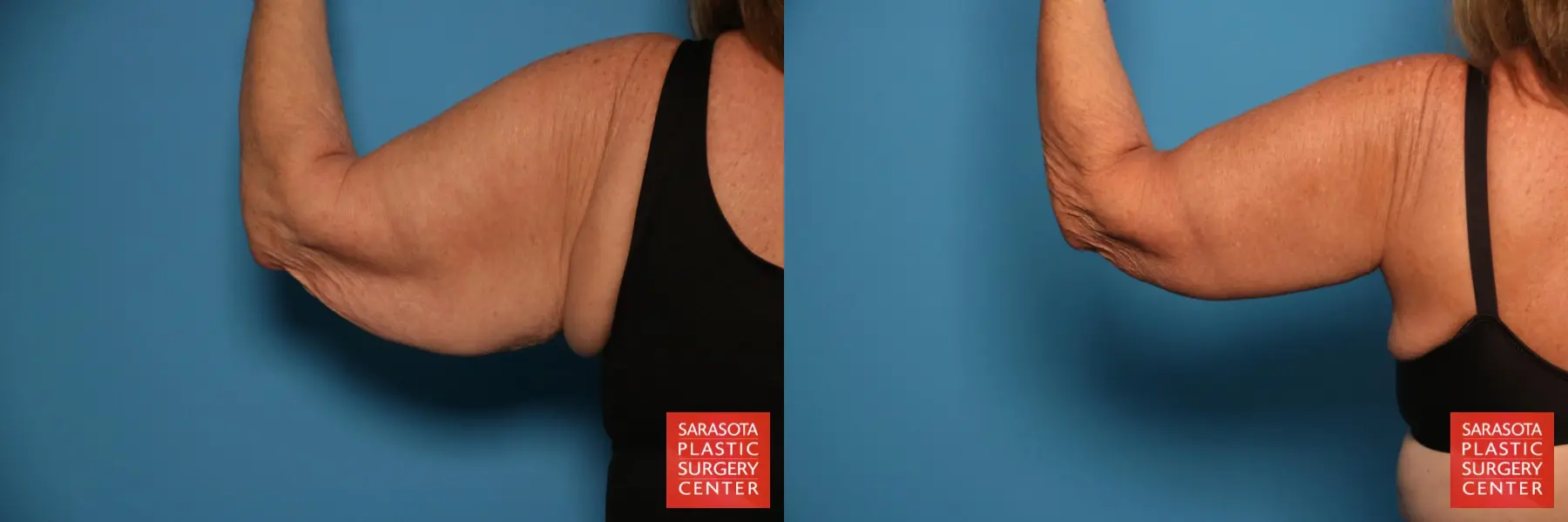 Arm Lift: Patient 23 - Before and After 6