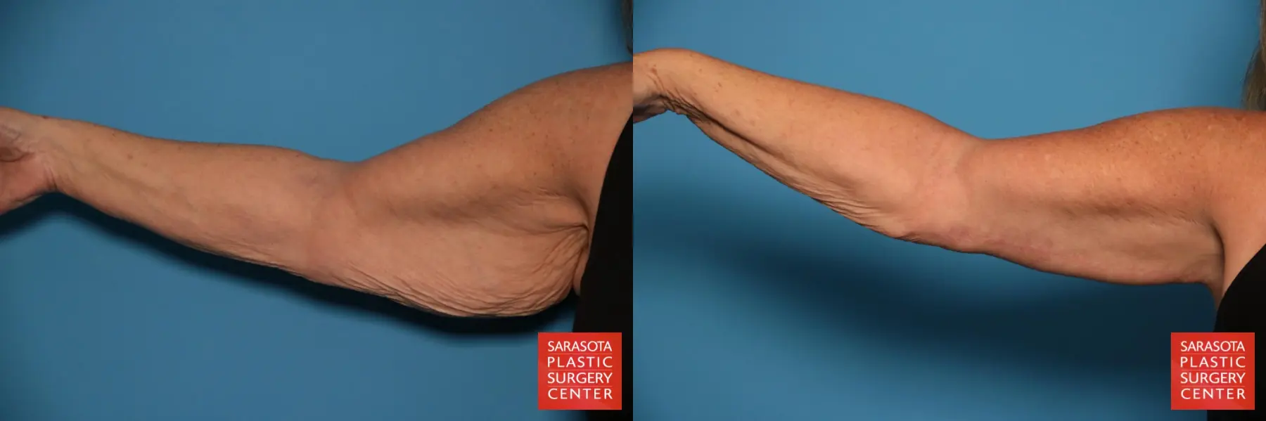 Arm Lift: Patient 23 - Before and After  