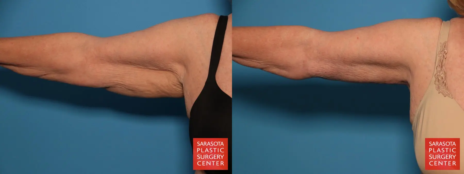 Arm Lift: Patient 26 - Before and After  