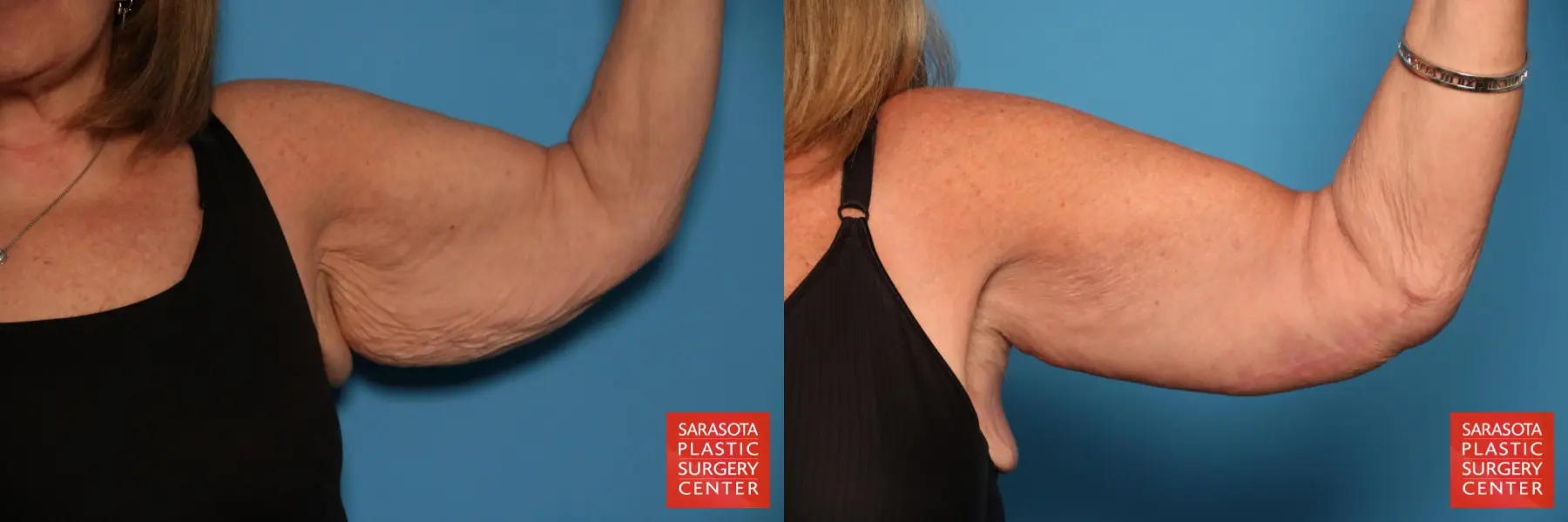 Arm Lift: Patient 23 - Before and After 4